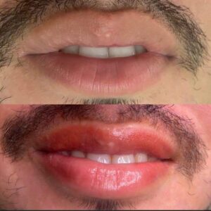 micropigmentación labios antes y después
